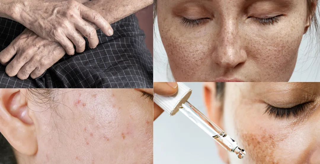 Pigmentasyon Bozuklukları