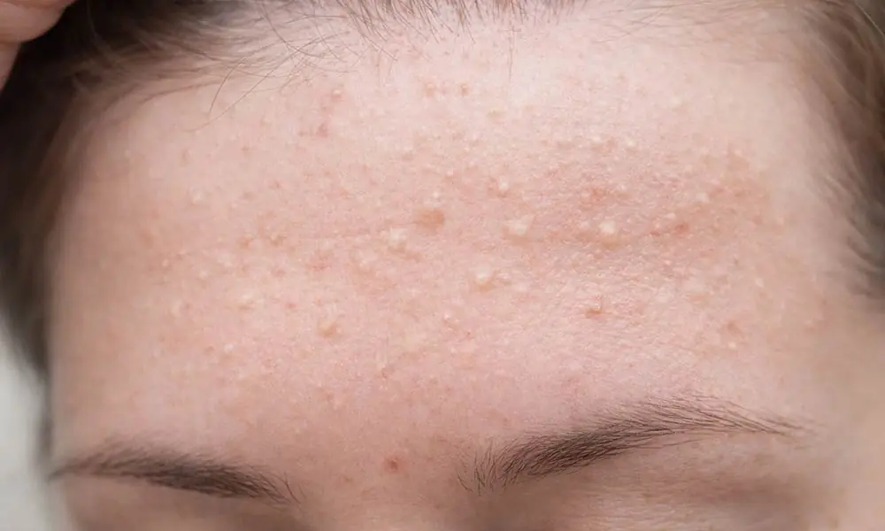 Sivilce neden çıkar