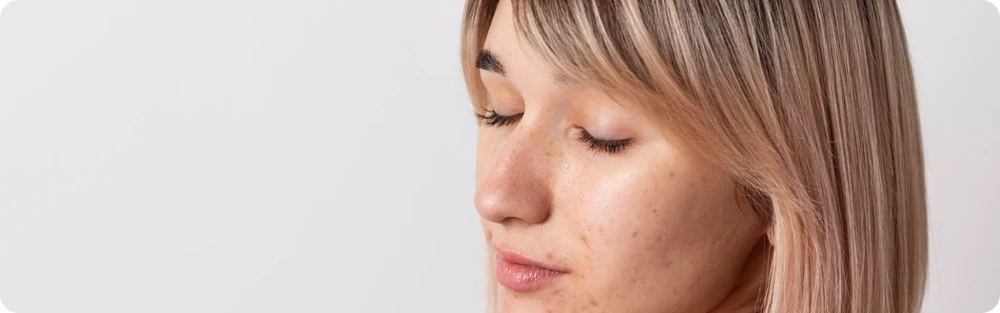 Cilt Lekeleri Nasıl Giderilir? En Etkili Leke Karşıtı Ürünler