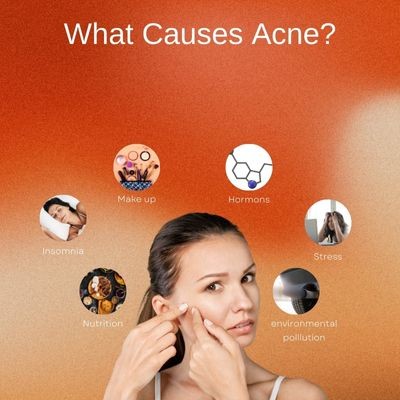 Bad Guests on the Skin: Acne