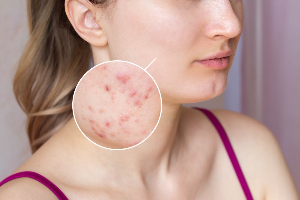 Salicylic Acid ve Glycolic Acid İçeren Tonikler ile Sivilce ve Yağlı Ciltlere Kalıcı Çözüm