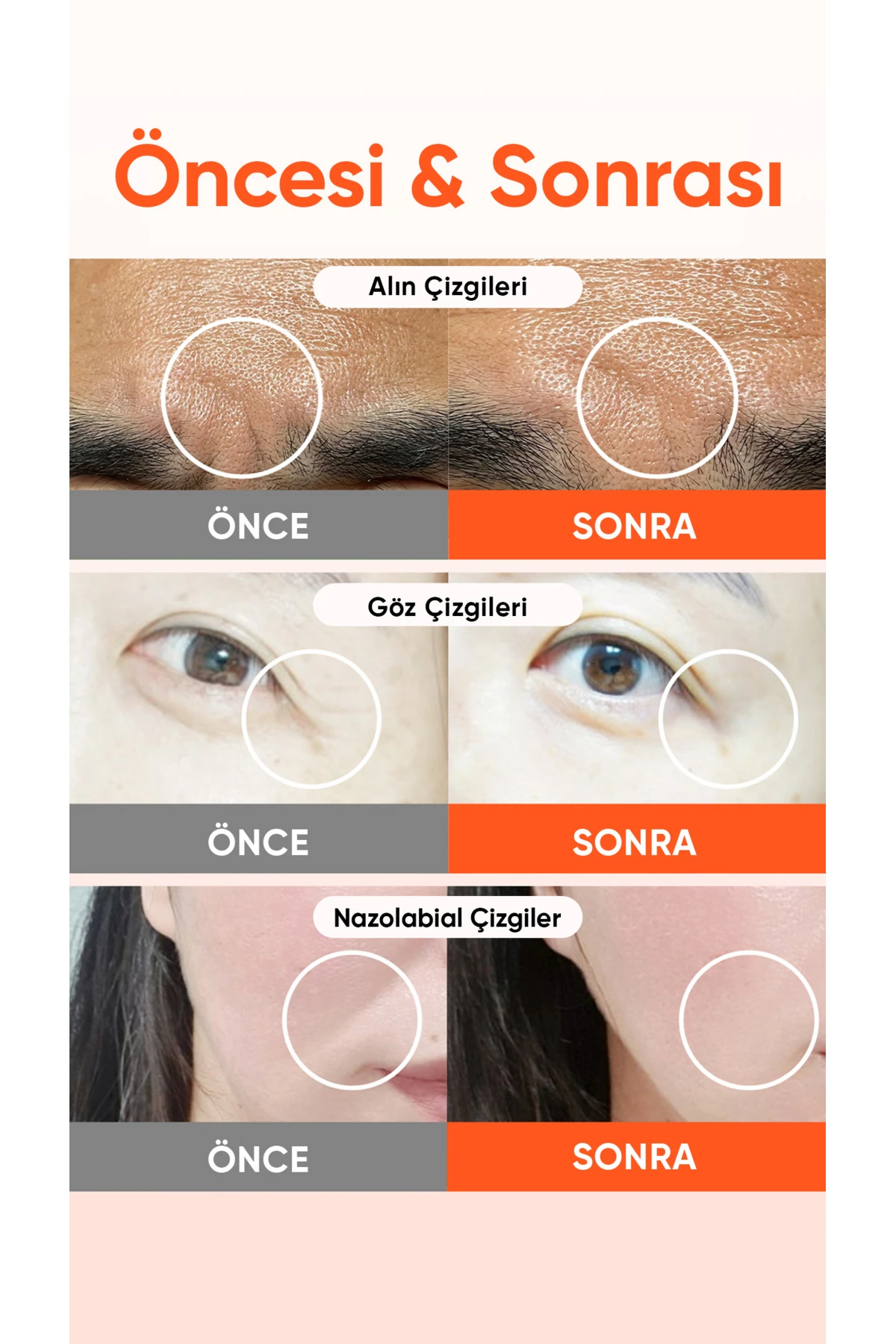 Retinol ve PDRN Mikro İğneli Alın Çizgisi Bandı Reti-rn Microcone Patch T Type 4lü