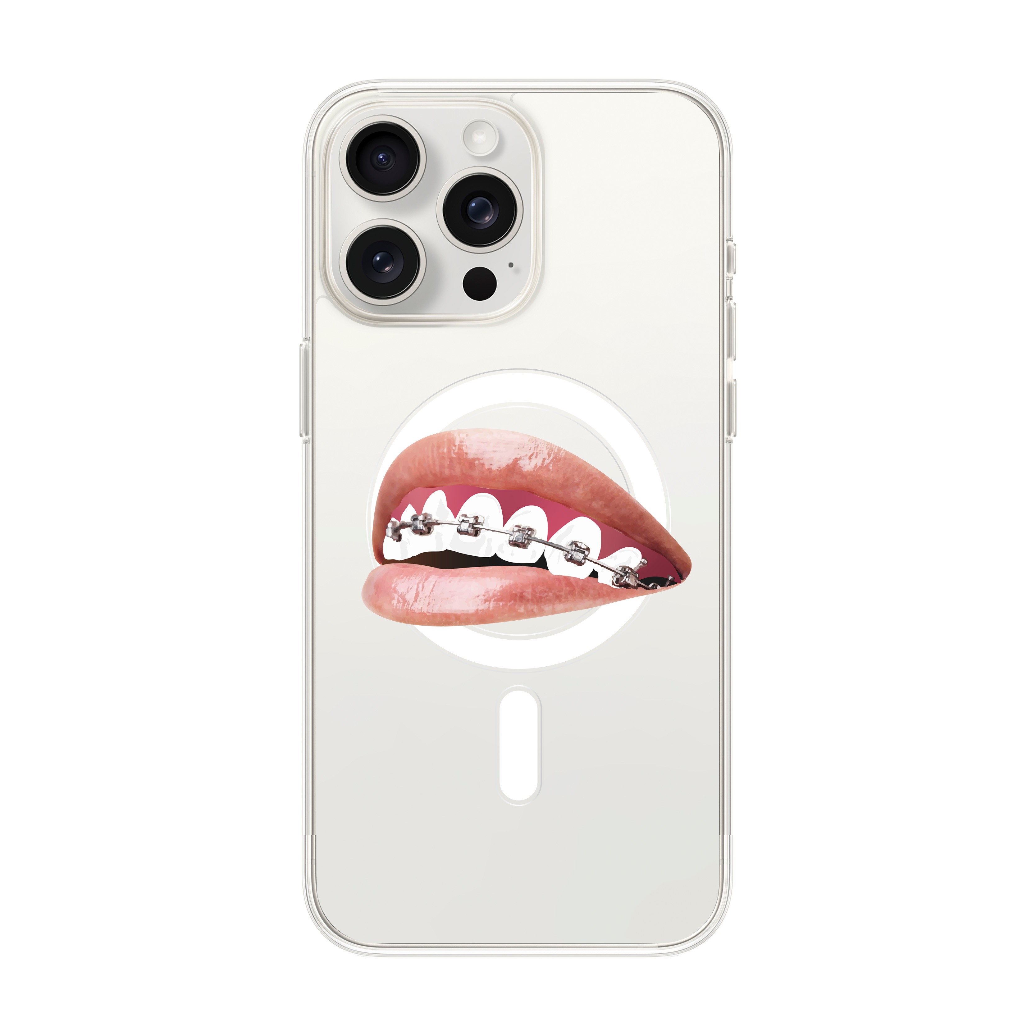 Orthodontist - iPhone Clear Case with MagSafe