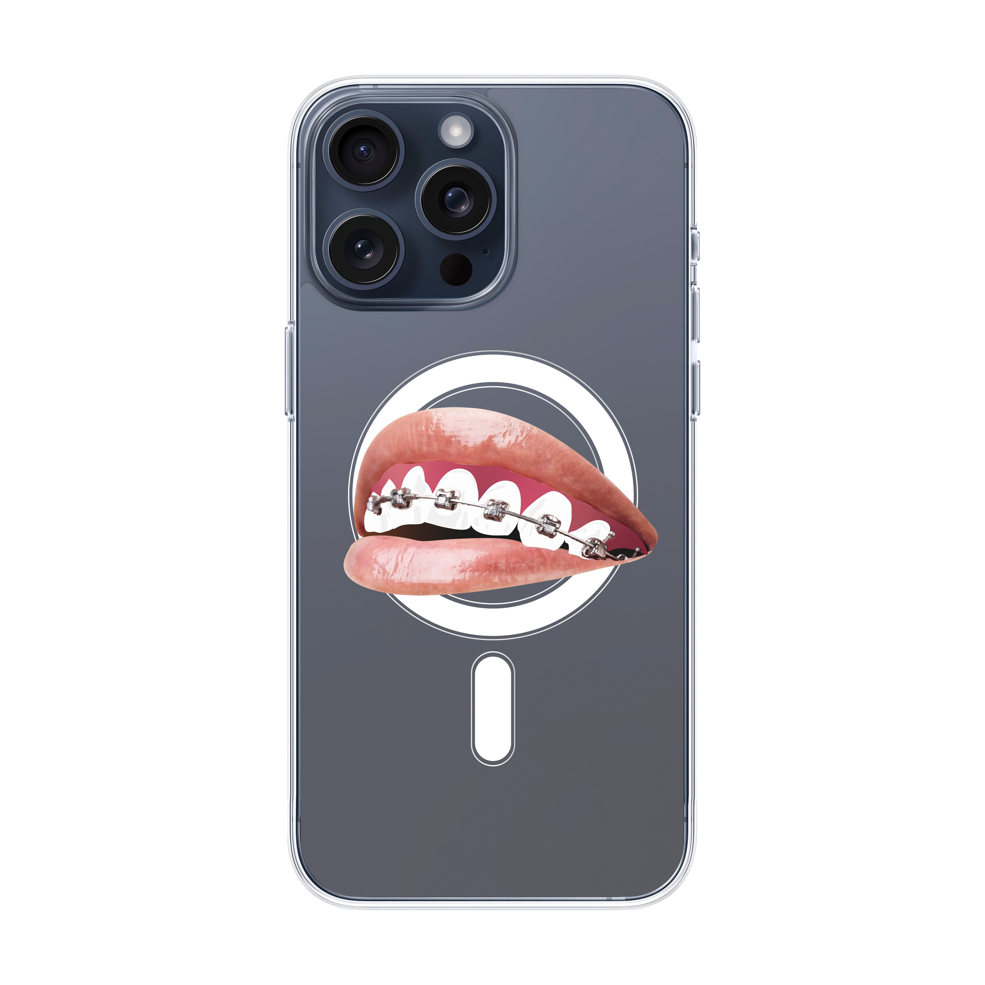 Orthodontist - iPhone Clear Case with MagSafe