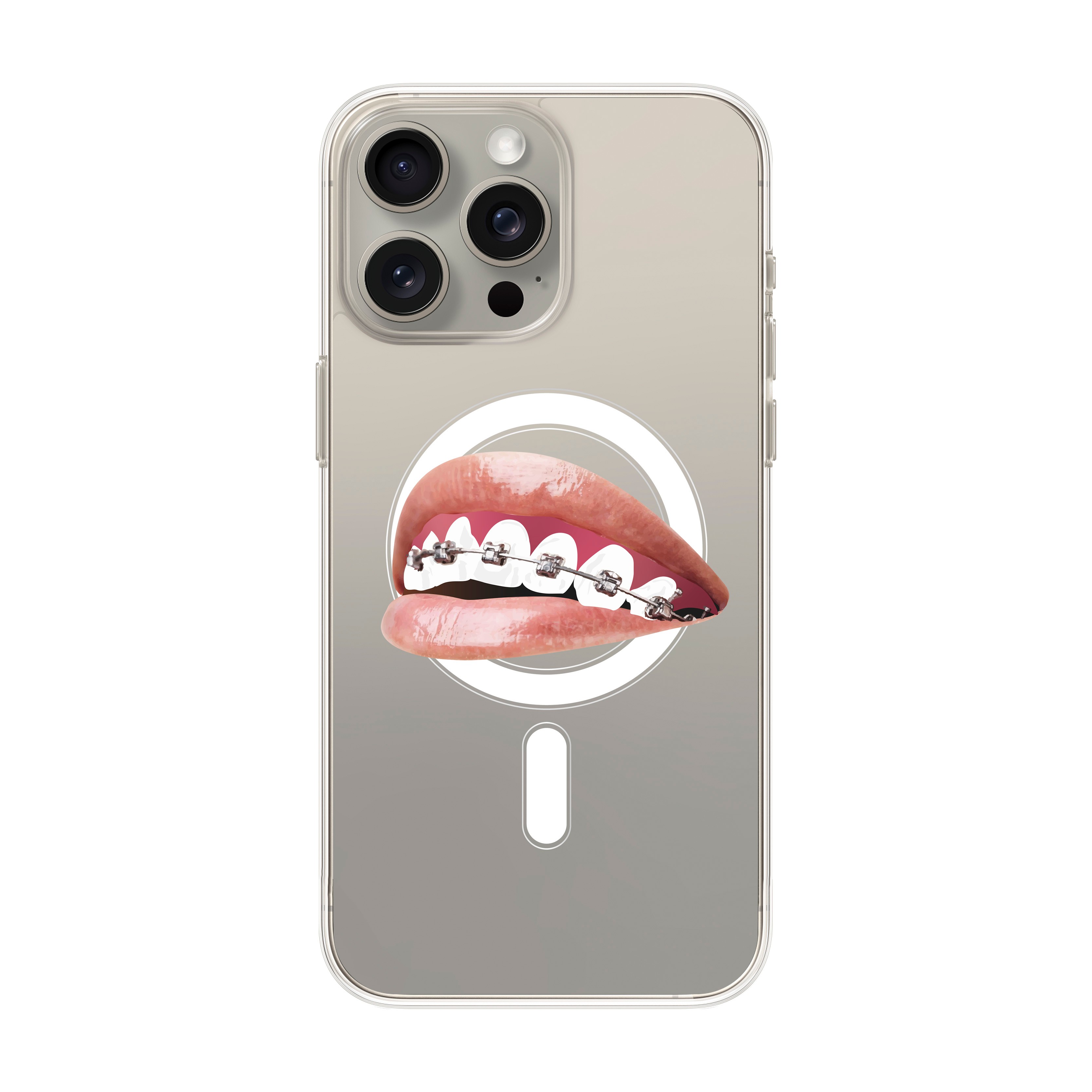 Orthodontist - iPhone Clear Case with MagSafe