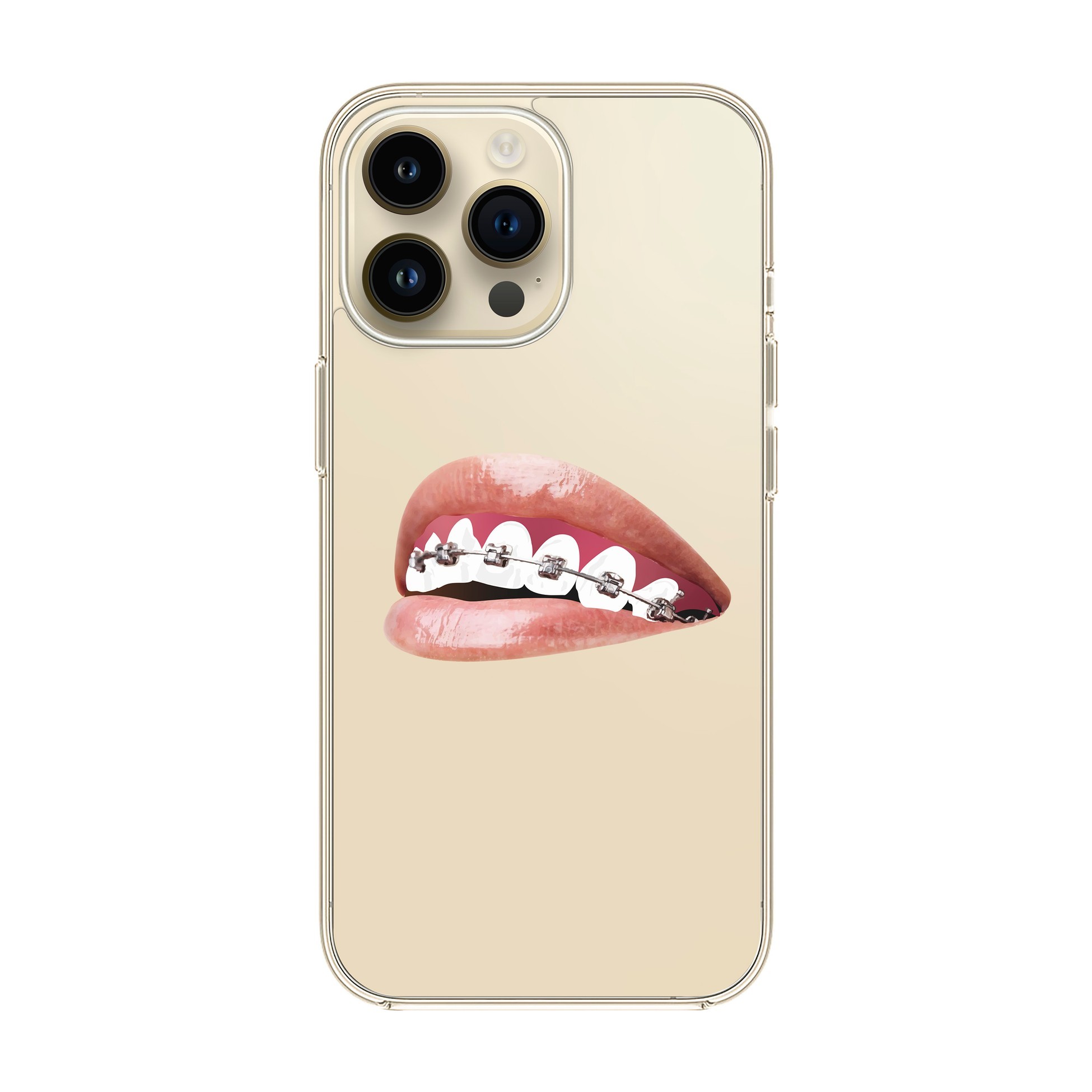 Orthodontist - iPhone Clear Case