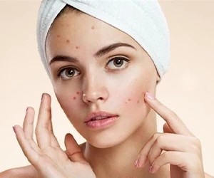 Anti-Acne Skin Care Guide