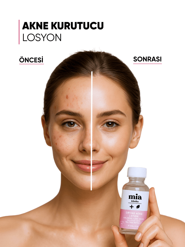 Mia Klinika Akne Kurutucu Losyon