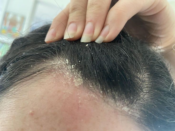 Sedef, Egzama, Kontakt Dermatit: Nedenleri, En Yeni Tedaviler ve Yaşam Kalitesini Artıran Çözümler