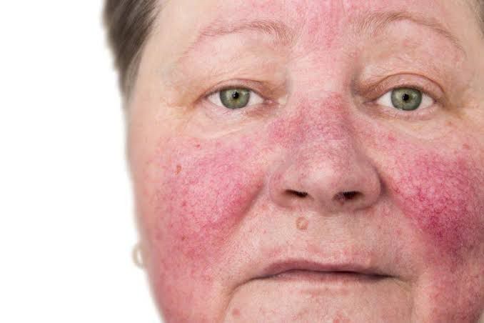 Rosacea Nedir? Neden ortaya çıkar? Nelere dikkat edilmeli? Cilt bakımı nasıl olmalı?
