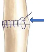 Tendon Tamirinde Sütür Teknikleri Hangi Yöntemler Etkili