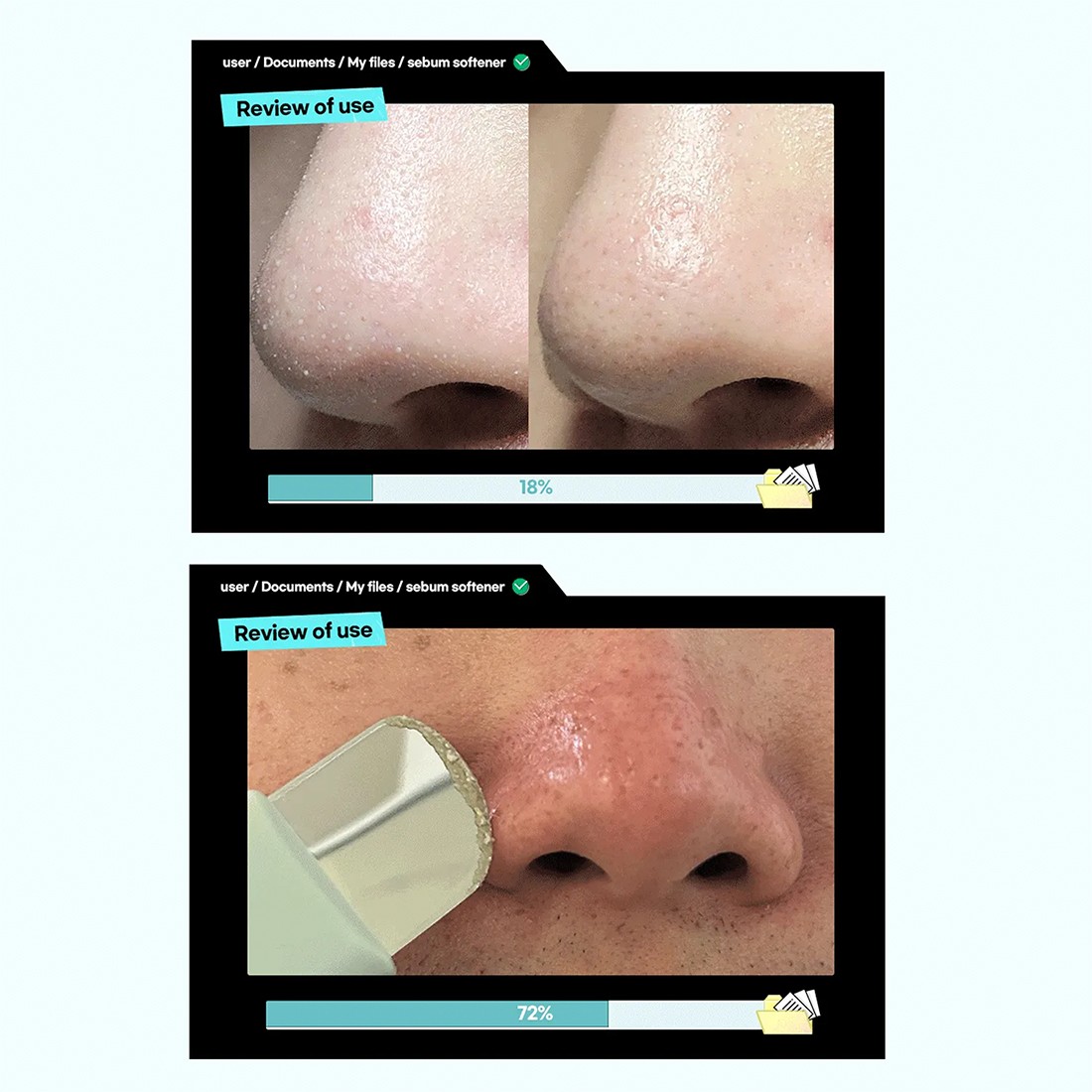 Ilso Deep Clean Master (Blackhead Remover) - Siyah Nokta Temizleyici