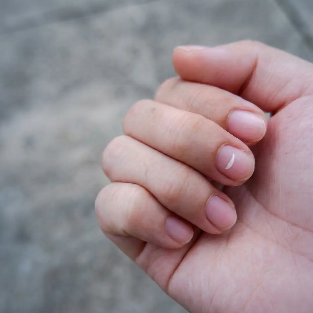 Kalsiyum eksikliği belirtileri: kemik ağrısı, kas krampları ve yorgunluk