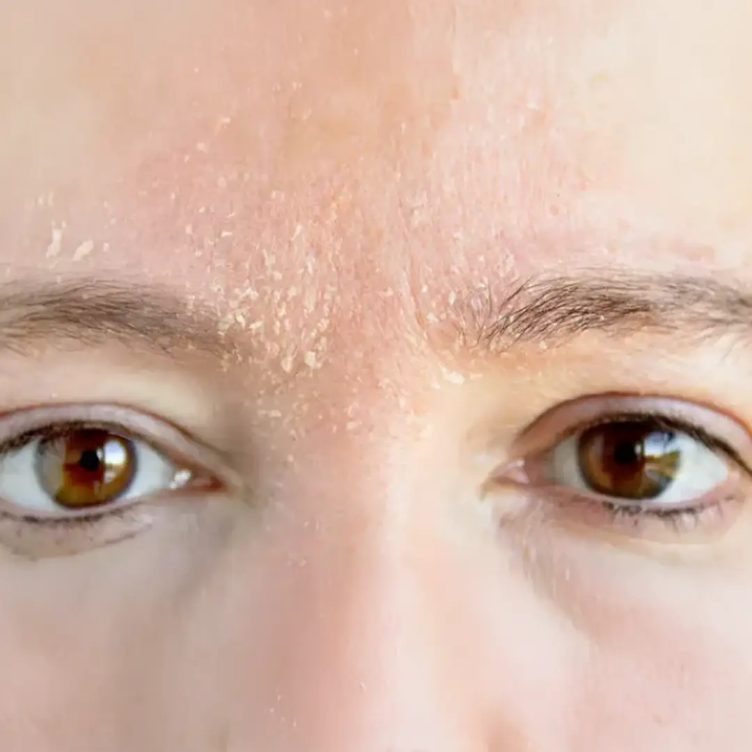 Soğuk hava ve düşük nem nedeniyle kuruyan cildi temsil eden kış temalı görsel.