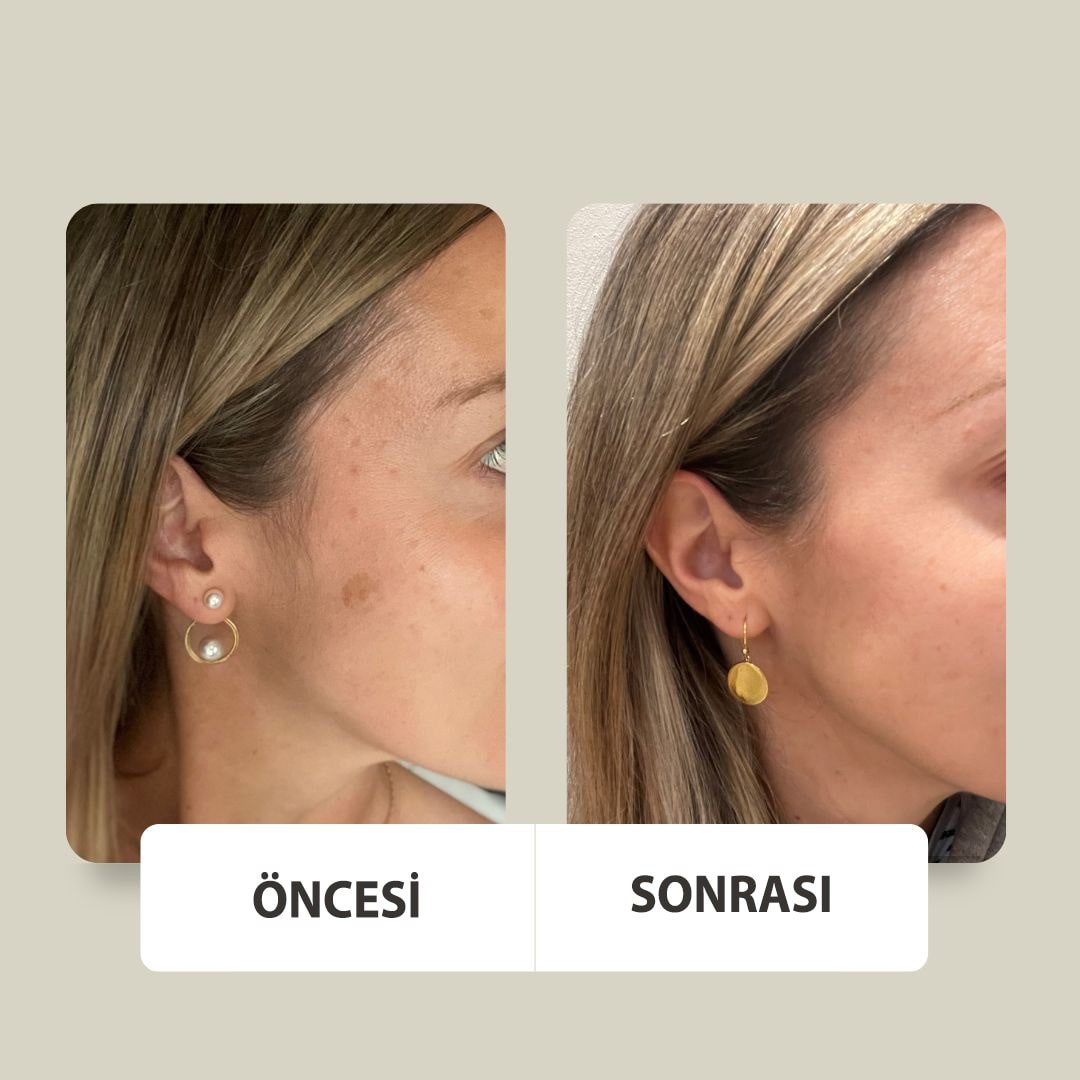 Siyah Nokta Karşıtı Gözenek Sıkılaştırıcı %10 Niacinamide Serum