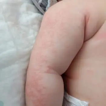 Egzama olmuş bir bebek. dikkatsizce seçilecek giysiler bu durumu daha da kötü yapabilir.