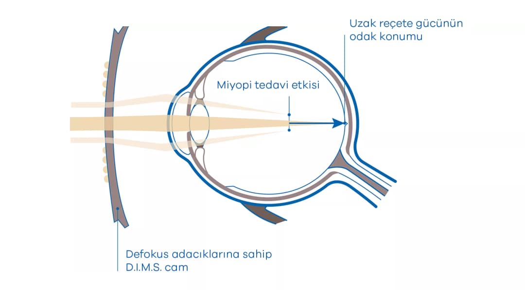 Miyopi kontrol camlarının çalışma prensibi diyagramı