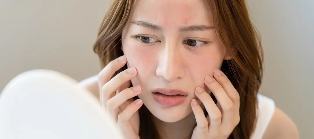 Hassas Cilt Nedir? Belirtileri ve Özellikleri