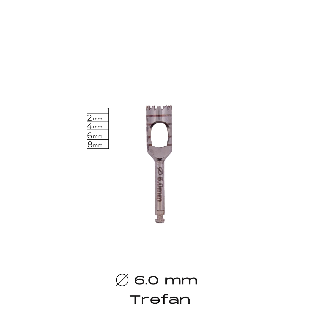 Trefan - 6.0mm