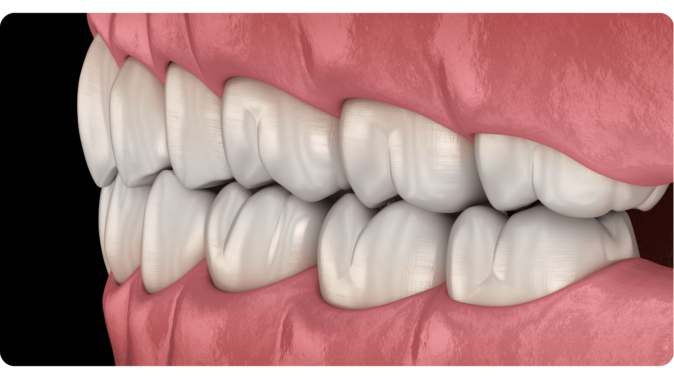 Dental Occlusions: Classification and Treatment Methods