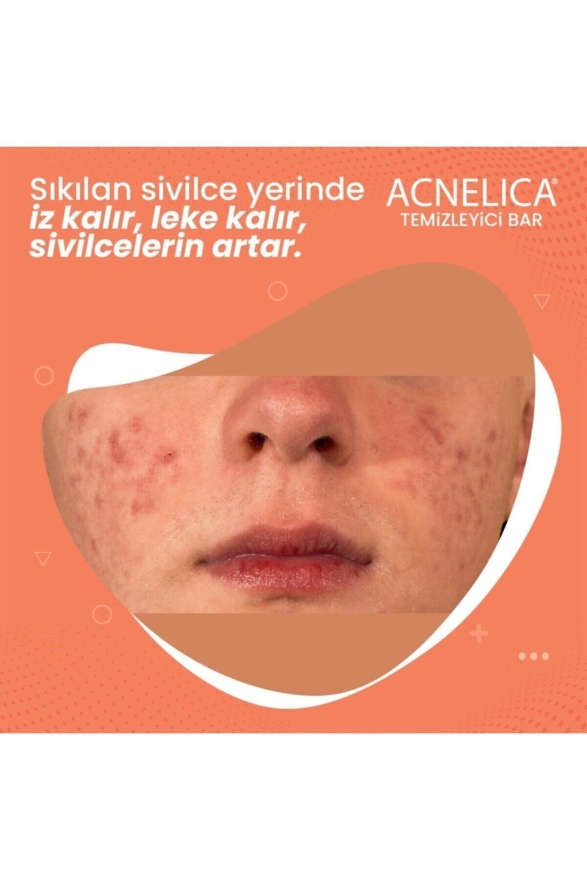 Temizleyici Bar %2 Siyah Nokta Ve Sivilce Sabunu