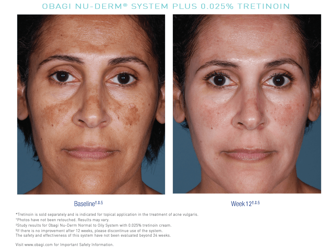 Obagi Nu-Derm System Kullanımı Öncesi ve Sonrası