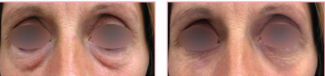Reduction of 120% of the dark cycle tone (ITAO).