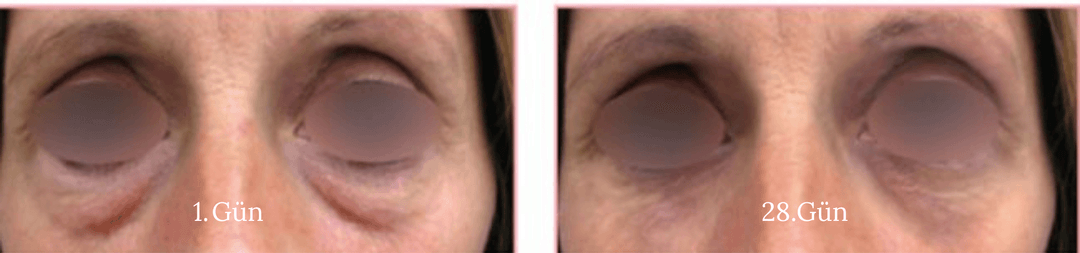 Reduction of 120% of the dark cycle tone (ITAO).