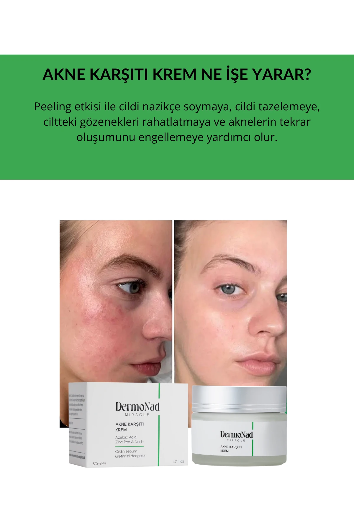 Akne Karşıtı Krem 50 ML (NAD+, Zinc PCA, Azelaic Asit)