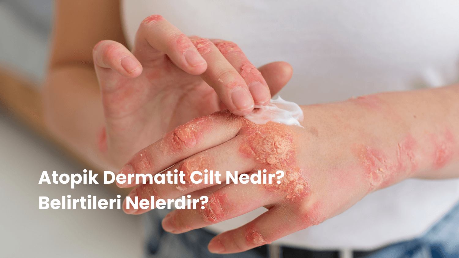 Atopik Dermatit Cilt Nedir? Belirtileri Nelerdir?