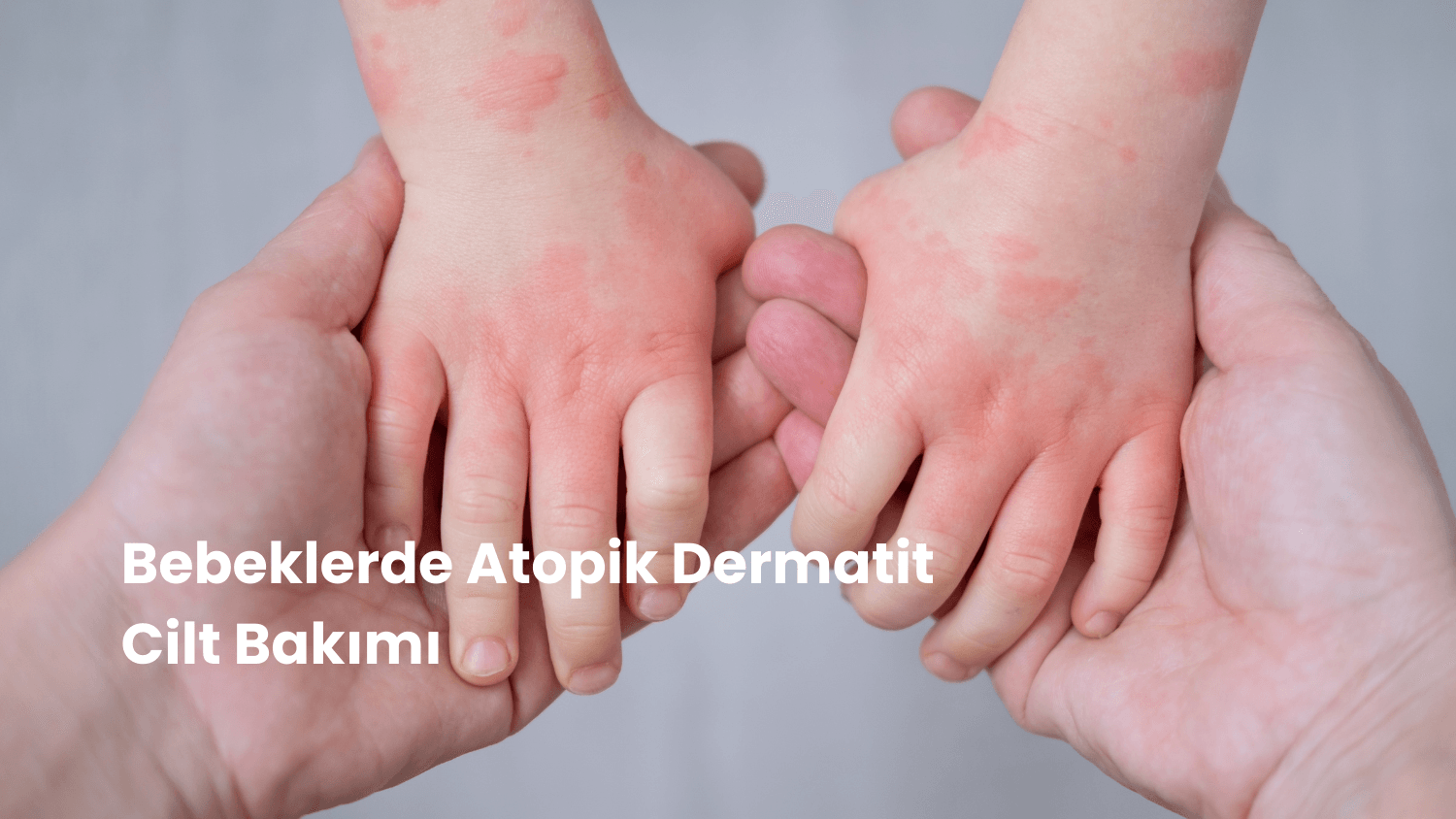 Bebeklerde Atopik Dermatit ve Cilt Bakımı